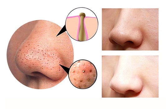 4-in-1 Facial & Body Skin Care Device – Gua Sha, Cupping, Blackhead Remover & Deep Pore Cleaner