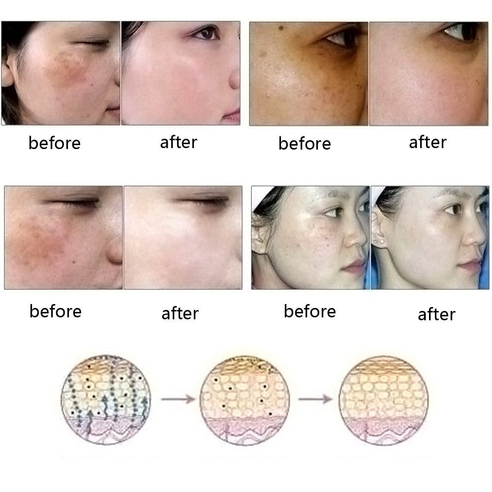 Scar & Stretch Mark Removal Essence Oil – Natural Acne Spot Treatment & Skin Repair Serum