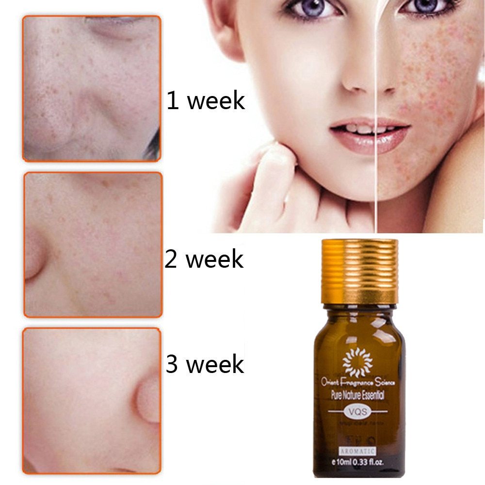 Scar & Stretch Mark Removal Essence Oil – Natural Acne Spot Treatment & Skin Repair Serum