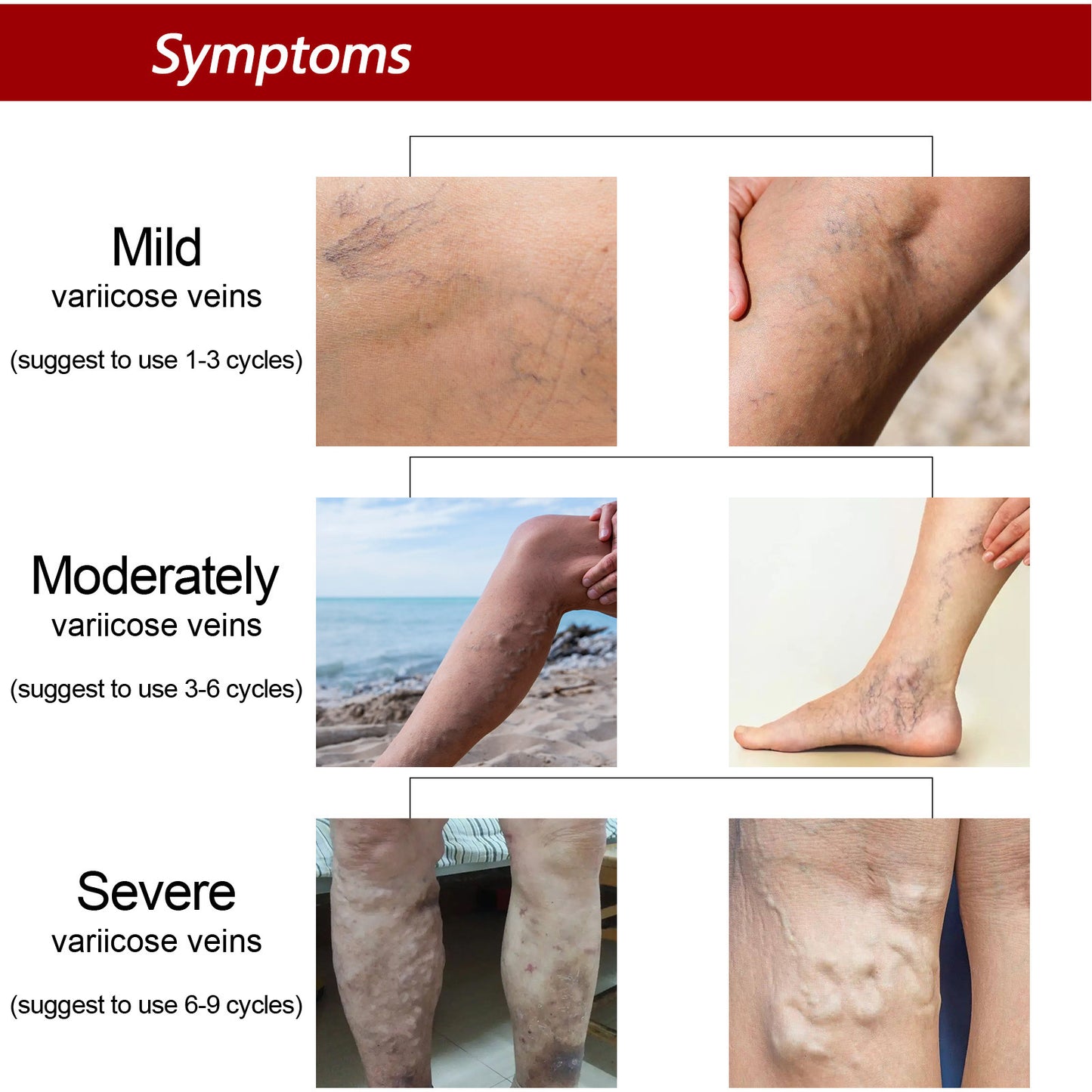 Earthworm Leg Vein Massage Cream For Relieving Leg Vascular Protrusion And Leg Swelling