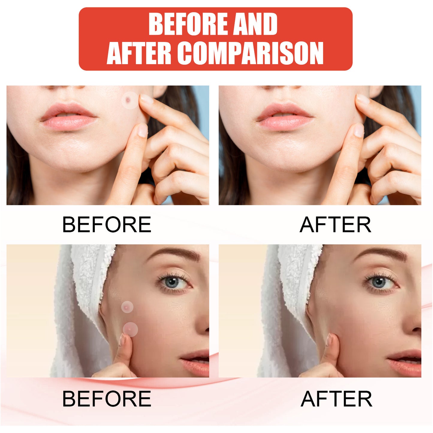 Hydrocolloid Acne Patch Makeup Closed Acne Patch